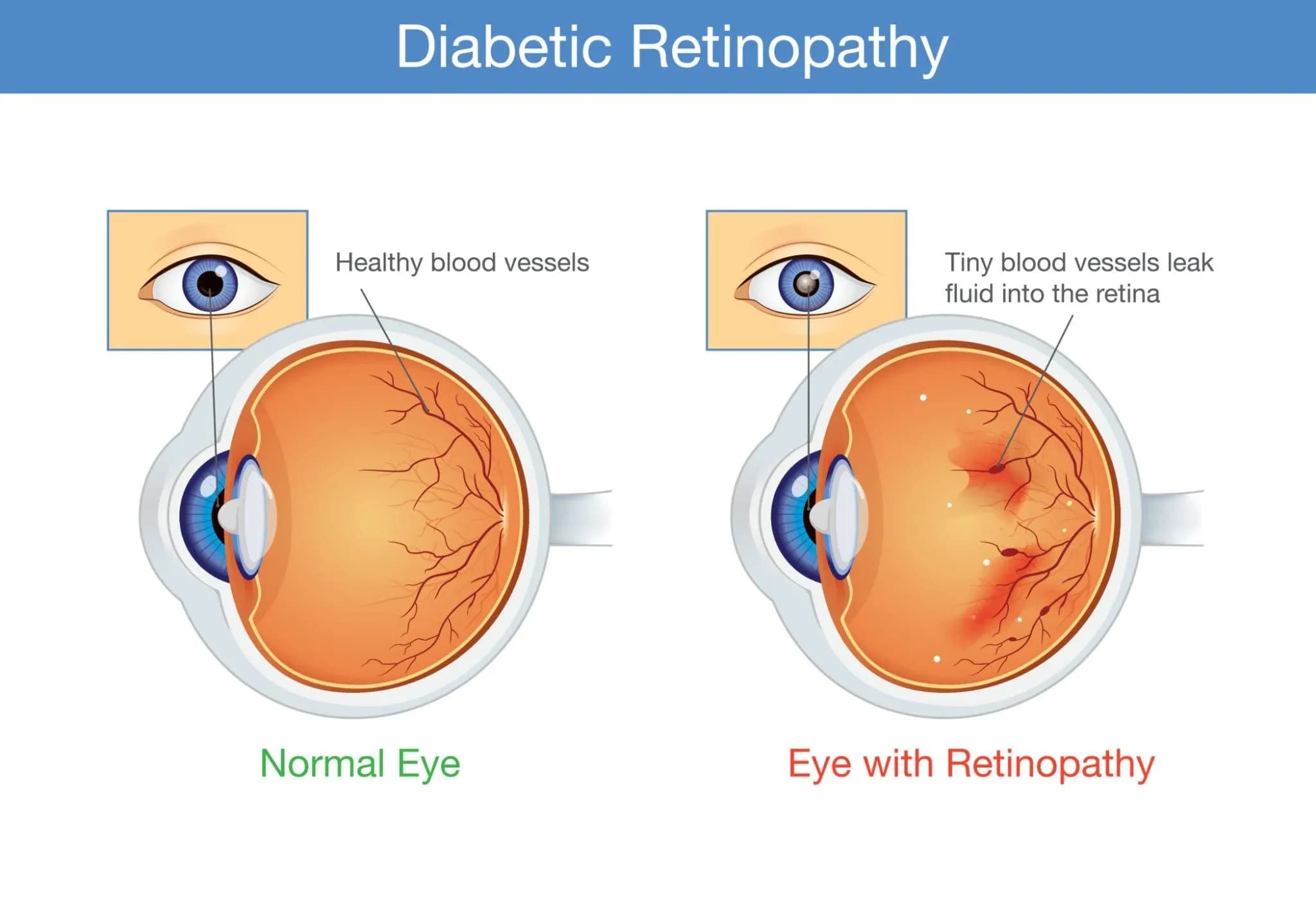 Understanding Diabetic Retinopathy