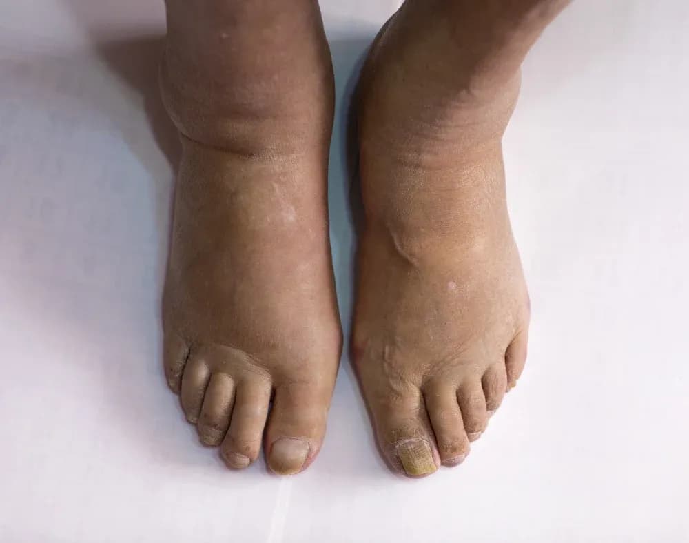 Why Diabetes Affects Your Feet and How to Prevent Swelling Naturally